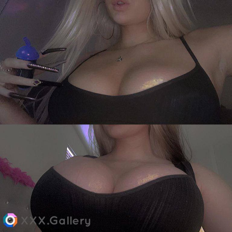 4 days after surgery... before and after, same top (; 850cc first time