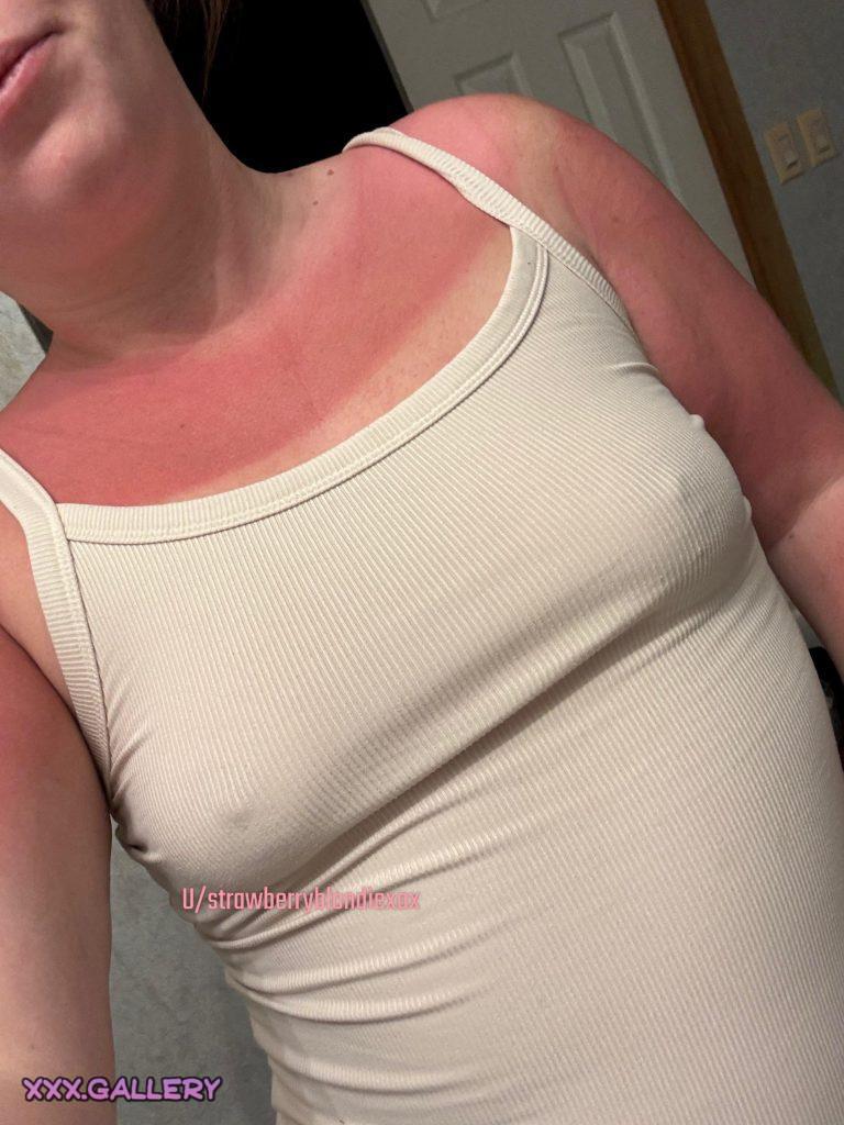 Tales of a Summer Sunburn